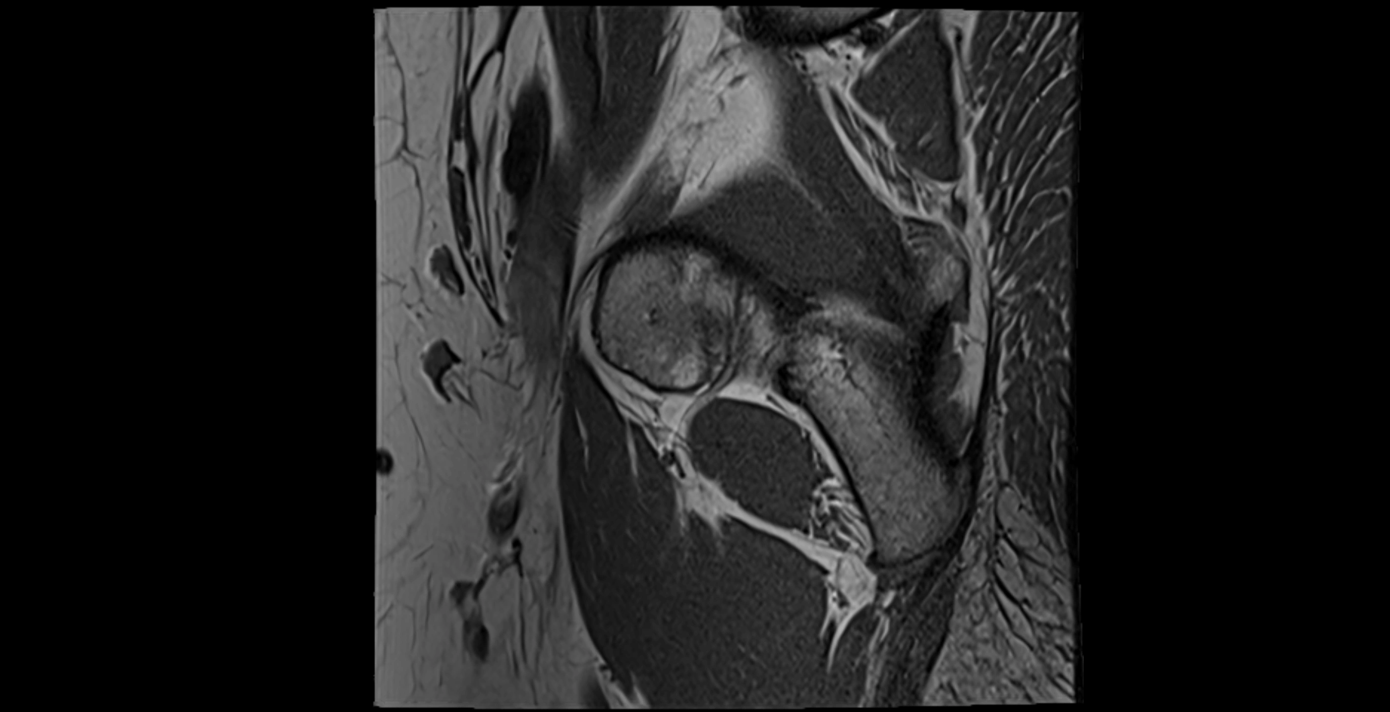 MRI Hip ligaments sagittal cross sectional anatomy 3T  radiology  image-img-00001-00001.webp